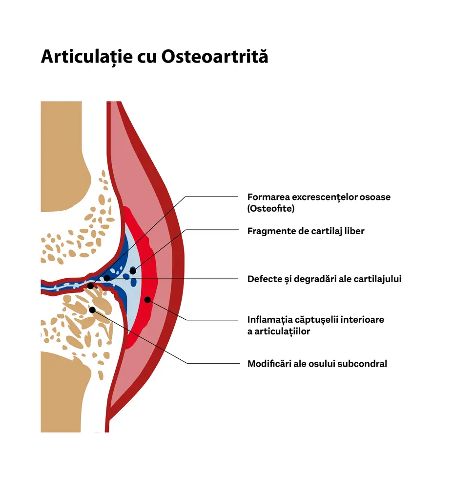 Imaginea ilustrează o articulație afectată de osteoartrită, evidențiind formarea excrescențelor osoase (osteofite), fragmente de cartilaj liber, defecte ale cartilajului, inflamația căptușelii interioare și modificări ale osului subcondral. Textul explică aceste aspecte anatomice.